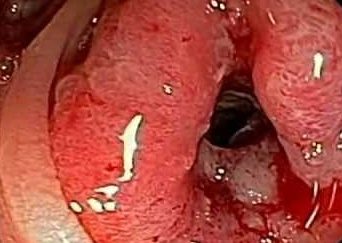 Colorectal cancer as seen during Colonoscopy